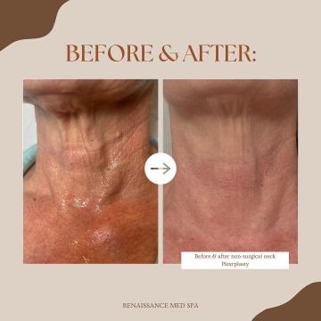 Neck Tightening Procedures Without Surgery