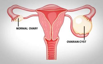 Comprehensive Ovarian Cyst Treatments in Gurgaon by Dr. Deepti Asthana