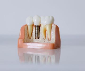 dental crowns chino hills