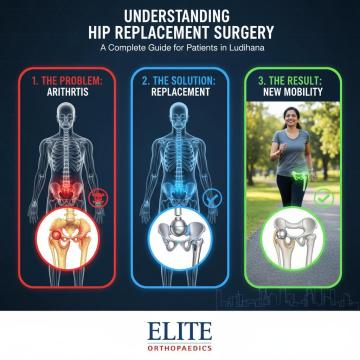 Understanding Hip Replacement Surgery: A Complete Guide for Patients in Ludhiana Hip pain can slowl