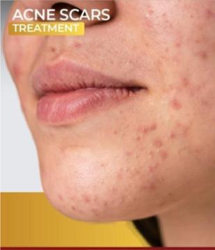 Clear Skin, Renewed Confidence!