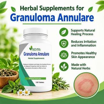 Best Supplements for Granuloma Annulare