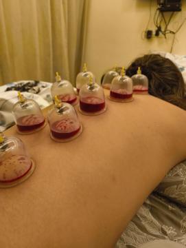Cupping Therapy in Jaipur – Relieve Pain & Boost Healing Naturally