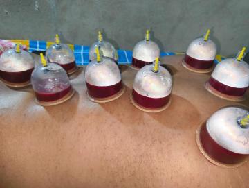 Cupping Therapy in Jaipur – Relieve Pain & Boost Healing Naturally