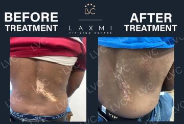 Homeopathic Vitiligo Treatment in Madurai | Laxmi Vitiligo Centre