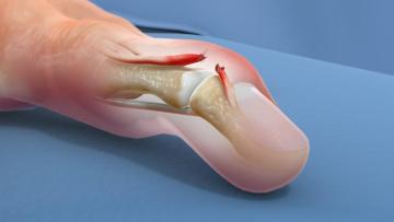 Best Doctor for Mallet Finger Injury in Delhi