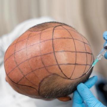 Best Hair Transplant Treatment in Hanamkonda