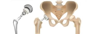 Hip Replacement Surgery in Ahmedabad | Trusted Orthopedic Care