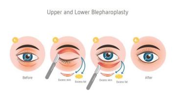 Eyelid surgery cost in Delhi - Dr Rajat Gupta