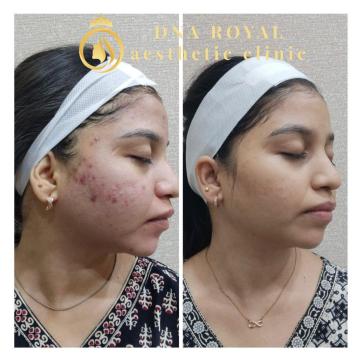 Melasma Treatment in Thane at DNA Royal: A Personalized Approach to Uneven Skin Tone