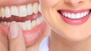 Miami Cosmetic Dentistry for Professional Teeth Whitening