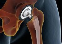Reliable Total Hip Replacement Surgery in Pune