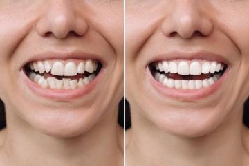 Teeth Whitening in Mississauga, Woodbridge, and Surrounding Areas