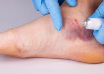 Effective Diabetic Foot Ulcer Treatment in India for Long-Term Relief