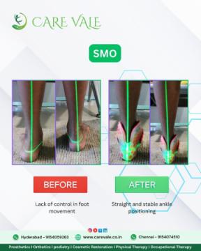 Best Artificial Leg in Hyderabad | CareVale Prosthetics