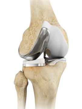 Robotic Unicondylar Knee Replacement