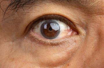 Cataract Treatment in Chinchwad