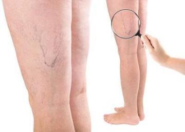 Vein Health Clinic Etobicoke