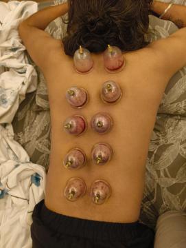 Cupping Therapy in Jaipur – Relieve Pain & Boost Healing Naturally