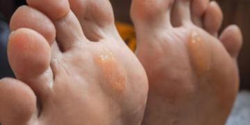 CuraFoot Expert Advice on Foot Corn Causes and Treatment