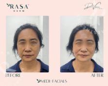 Glow Like Never Before with Rasaderm’s Carbon Facial