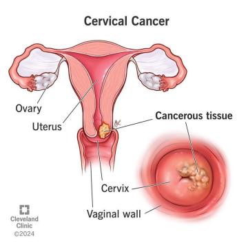 Cervical Cancer Surgeon in Delhi