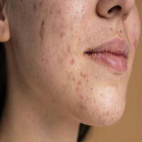 Acne treatment near me in Bhubaneswar