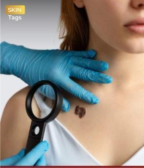 Safe & Quick Skin Tags Removal in Delhi