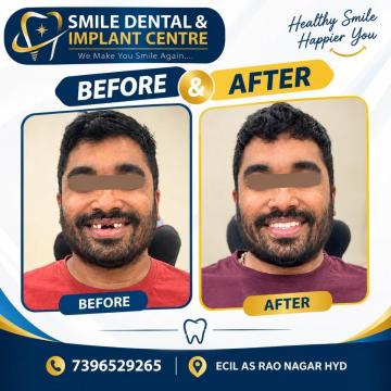 See the Difference: Real Zirconia Teeth Transformation!