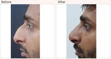 Nose surgery cost in Delhi - Dr Rajat Gupta