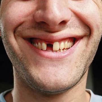 Missing Tooth Replacement in Madhapur