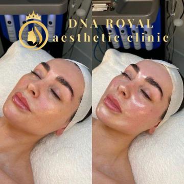 Hydrafacial Treatment in Thane at DNA Royal | Refresh Your Skin with Advanced Skincare