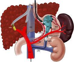 Role of Portal Hypertension Radiology in Liver Disease
