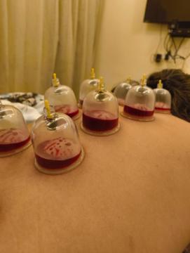 Cupping Therapy in Jaipur – Relieve Pain & Boost Healing Naturally