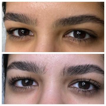 Microneedling Service Pembroke Pines FL