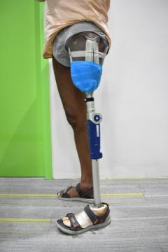 Best Prosthetic Leg Clinic in Hyderabad | CareVale Prosthetics