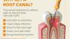 Root Canal Treatment in mulund