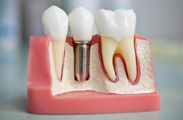 Dental Implant Treatment in Nashik | Dental Design Clinic