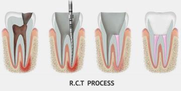 Save Your Tooth – Advanced Root Canal Treatment in Noida
