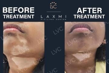 Homeopathic Vitiligo Treatment in Madurai | Laxmi Vitiligo Centre