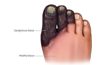 Gangrene Treatment in Ludhiana
