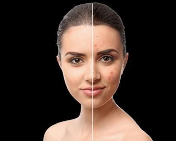 Best Mesotherapy Skin Treatments in Abu Dhabi | Bioclinic
