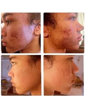 Affordable Facial Oakland for Radiant & Smooth Skin