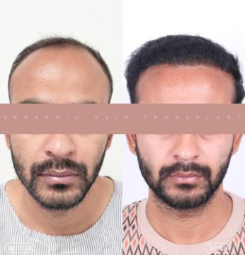 Hair Transplant in Indore | Trusted Experts for Natural Hair Restoration