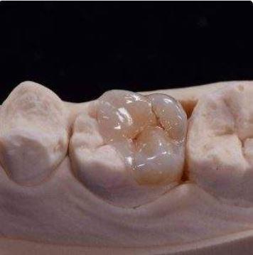 Premier Emax Teeth Supplier for Dental Labs & Clinics