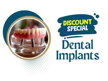 Grab offers and deals on tooth implants solution