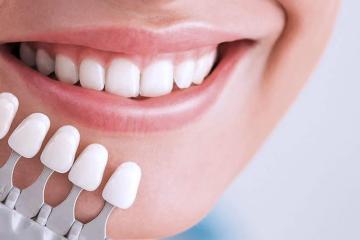 Veneers Surrey BC