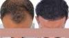Hair Transplant in Indore | Trusted Experts for Natural Hair Restoration