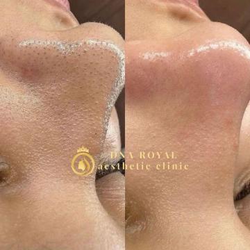 Hydrafacial Treatment in Thane at DNA Royal | Refresh Your Skin with Advanced Facial Care