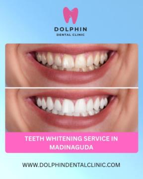 Professional Teeth Whitening Service in Madinaguda – Brighten Your Smile Naturally